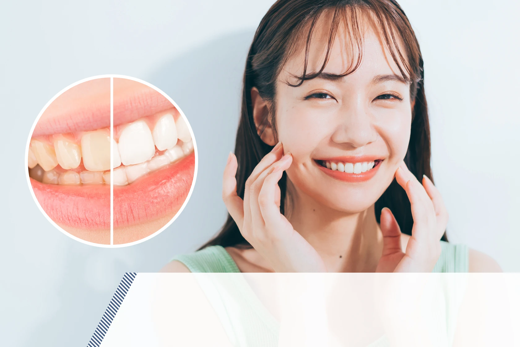 ホワイトニング