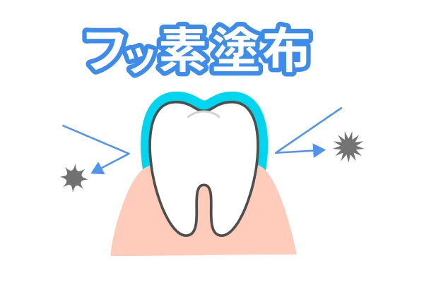 フッ素塗布をして歯質強化