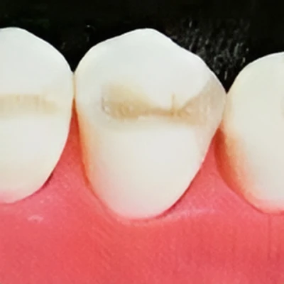 ハイブリッドセラミッククラウン