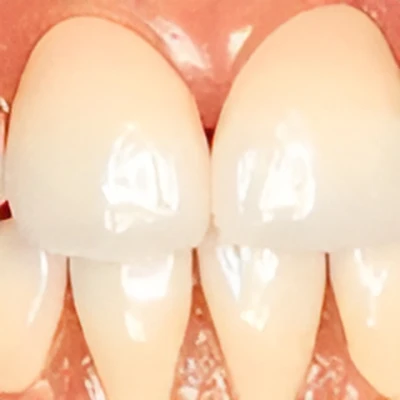 オールセラミッククラウン